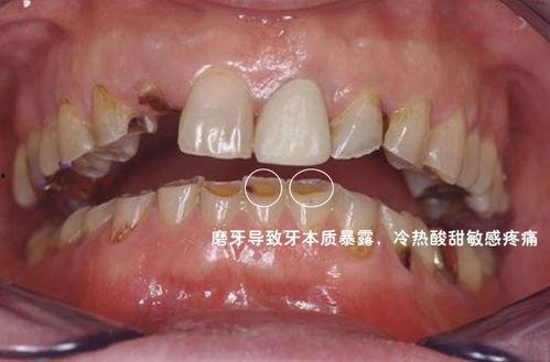 磨牙神器成人治疗视频,揭秘成人治疗磨牙症的神奇之旅