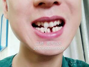 成人高角型正畸视频